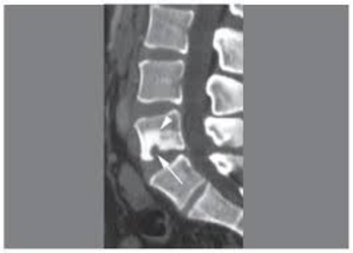 Medicofit-schmorlova-hernija