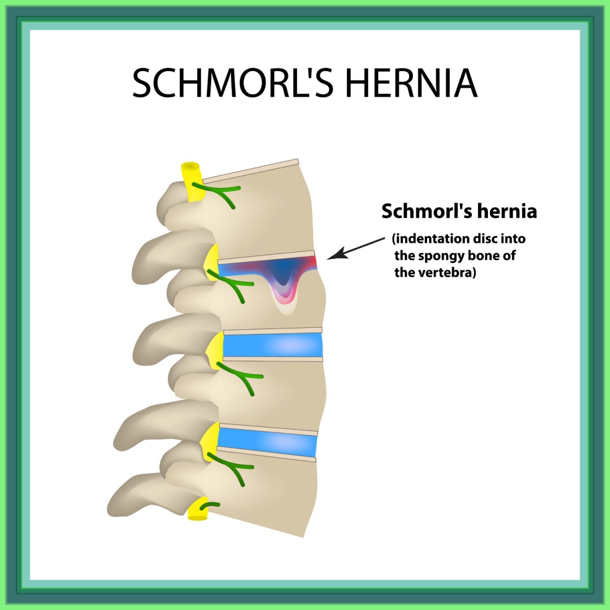 Schmorlova-hernija-fizioterapija