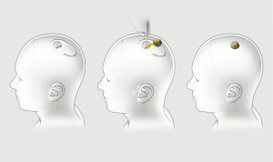 Človek s čipom v možganih z mislimi premika računalniški kazalec